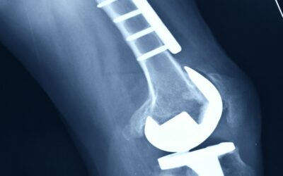 Jakie są różnice w występowaniu powikłań po różnych typach osteotomii?