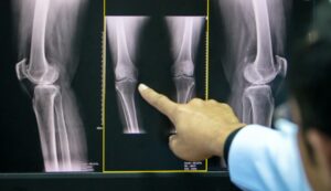osteotomia-kolana